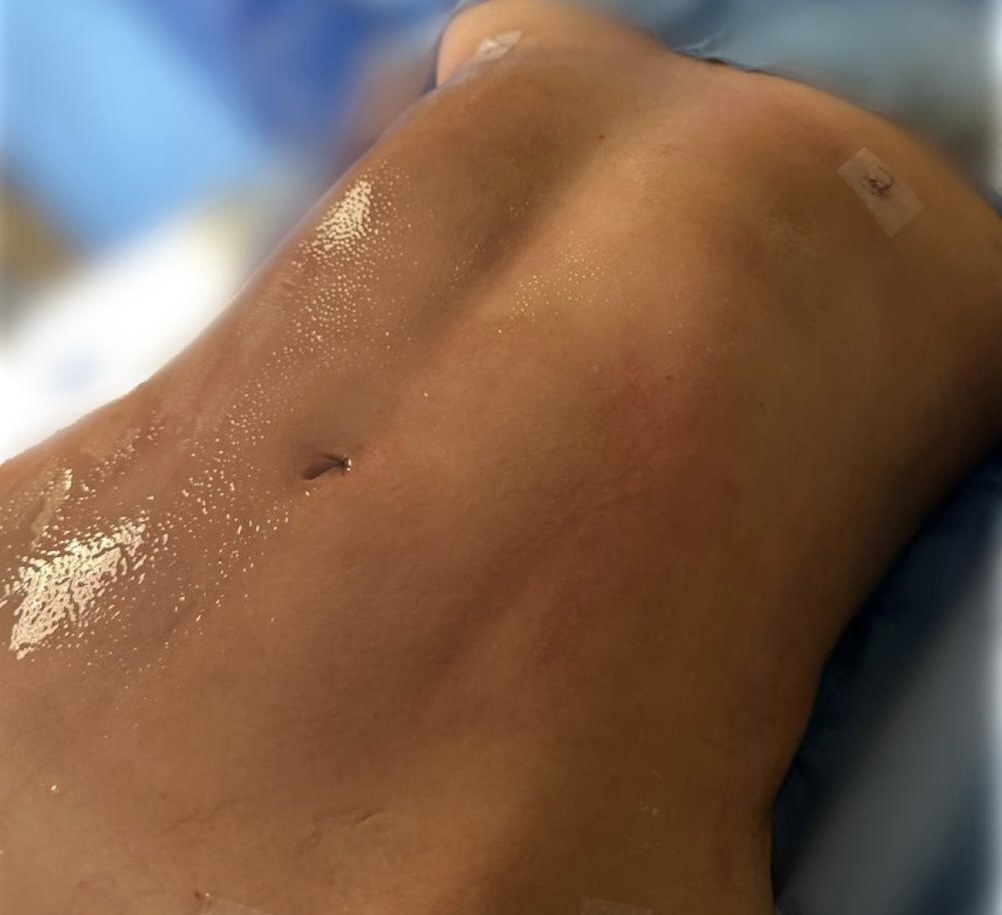 Cuidado cirúrgico da região abdominal